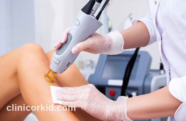 لیزر الکساندرایت | کلینیک ارکید