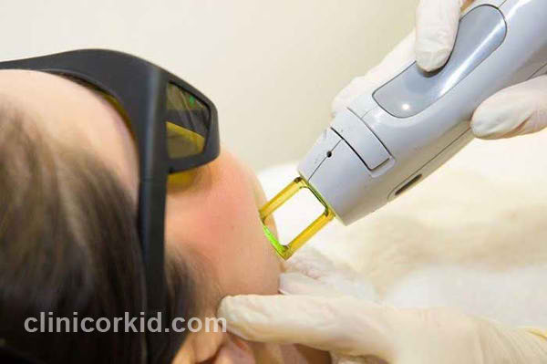 لیزر الکساندرایت | کلینیک ارکید