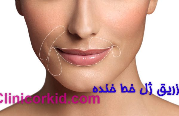 تزریق ژل خط خنده کلینیک ارکید