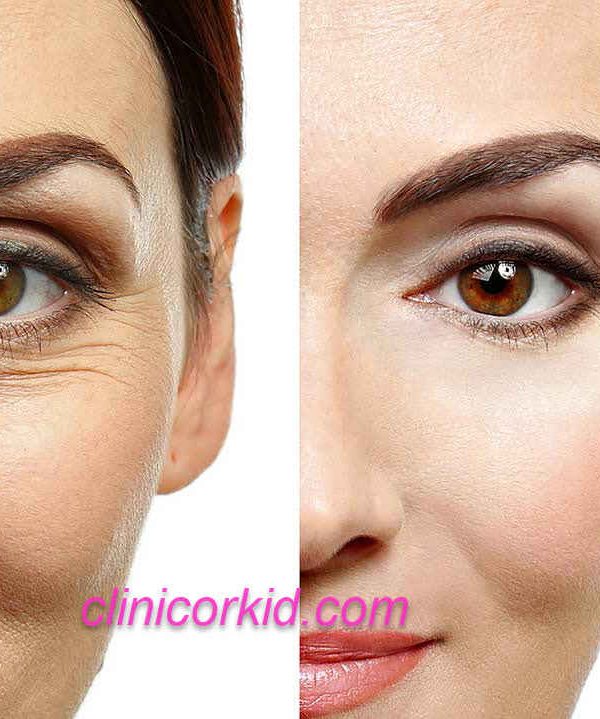 رفع چروک های اطراف چشم کلینیک ارکید