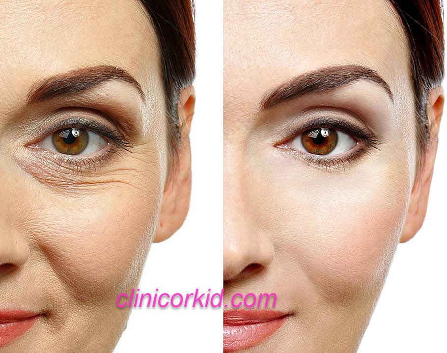 رفع چروک های اطراف چشم کلینیک ارکید