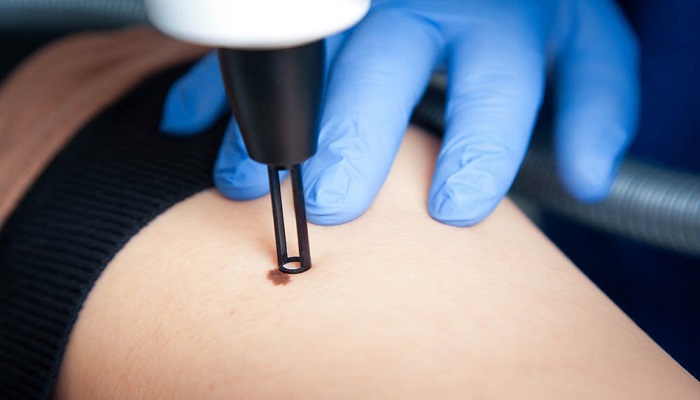 راه های برداشت خال صورت و بدن