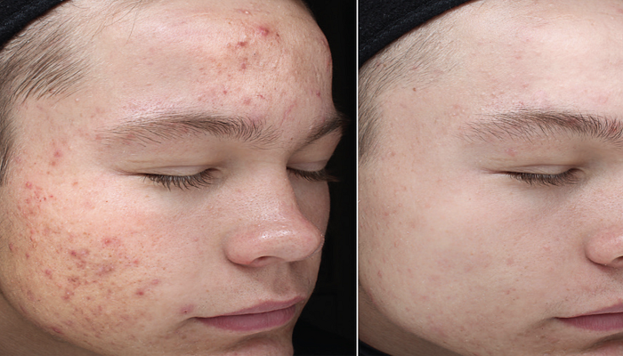 بهترین راه درمان لک های صورت