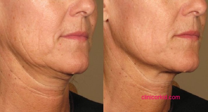 بهترین مرکز هایفوتراپی در پونک - کلینیک ارکید