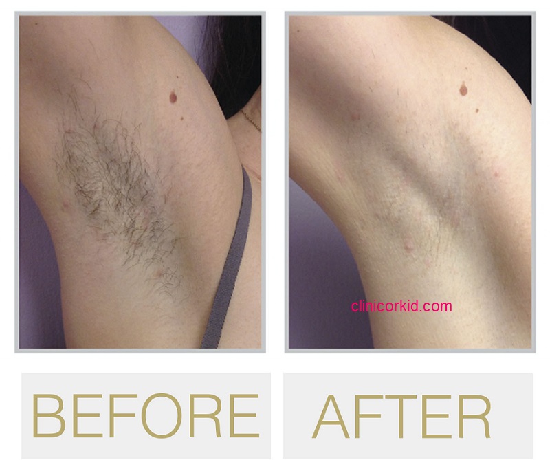 قیمت لیزر موهای زائد در پونک - کلینیک ارکید