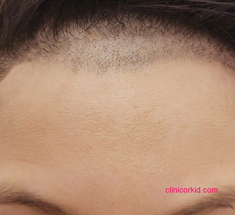 قیمت لیزر موی پیشانی - کلینیک ارکید