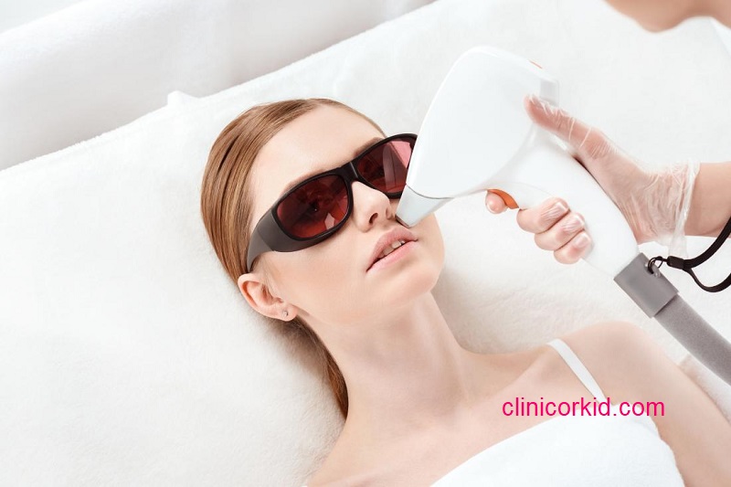 مزایای لیزر موهای زائد - کلینیک ارکید