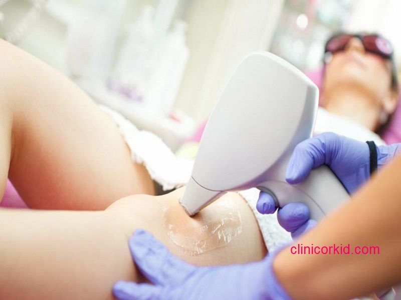 قیمت لیزر موهای زائد کلینیک ارکید