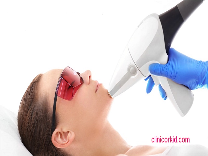 هزینه لیزر موهای زائد چانه کلینیک ارکید