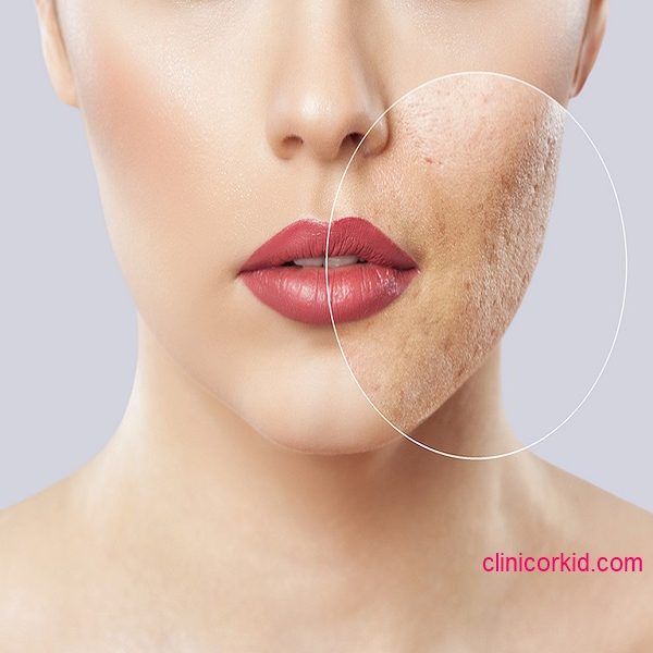 بهترین روش جوانسازی و رفع جای جوش کلینیک ارکید