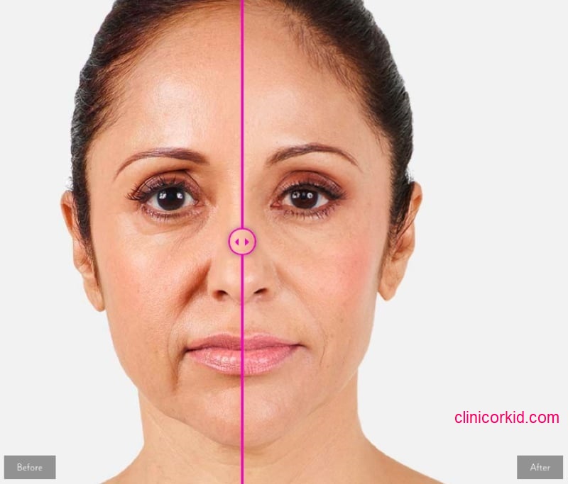 تزریق ژل خط خنده در غرب تهران - کلینیک ارکید