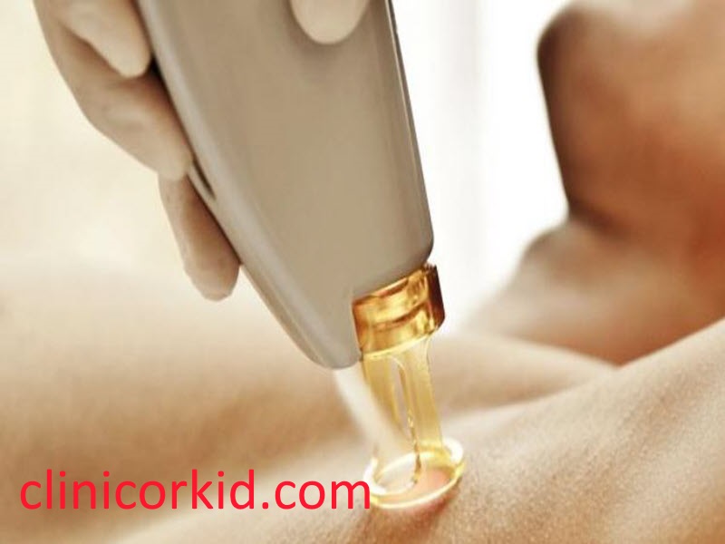 الکترولیز موهای زائد-کلینیک ارکید