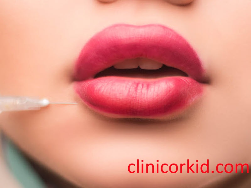 بهترین نوع ژل لب- کلینیک ارکید