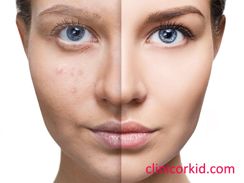 مزیت های میکرونیدلینگ صورت-کلینیک ارکید