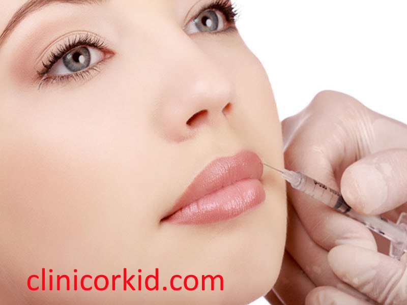 هزینه تزریق ژل لب-کلینیک ارکید