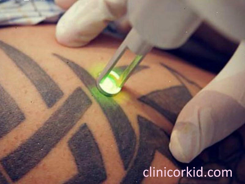 روش های پاک کردن تاتو بدن-کلینیک ارکید