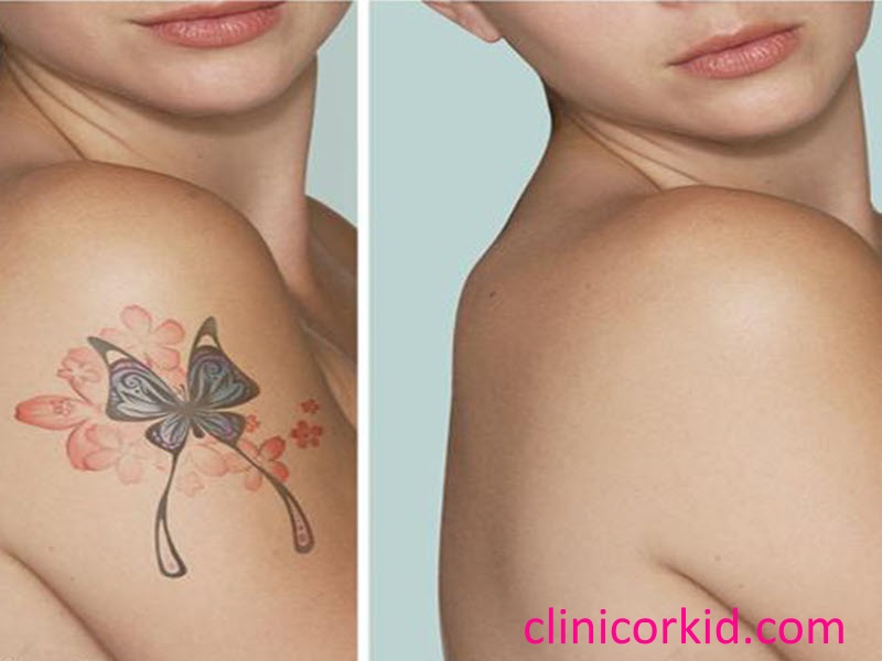 هزینه پاک کردن تاتو بدن کلینیک ارکید