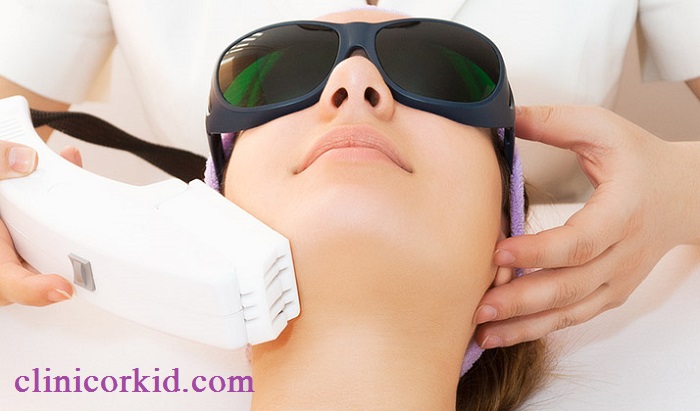 قیمت لیزر موهای زائد چانه - کلینیک ارکید