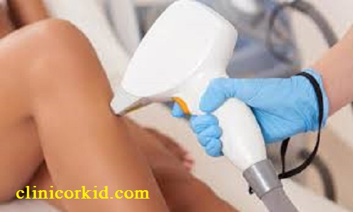 لیزر موهای زائد زنان در غرب تهران کلینیک ارکید