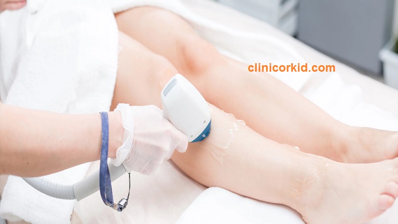 قیمت لیزر موهای بدن بانوان - کلینیک ارکید