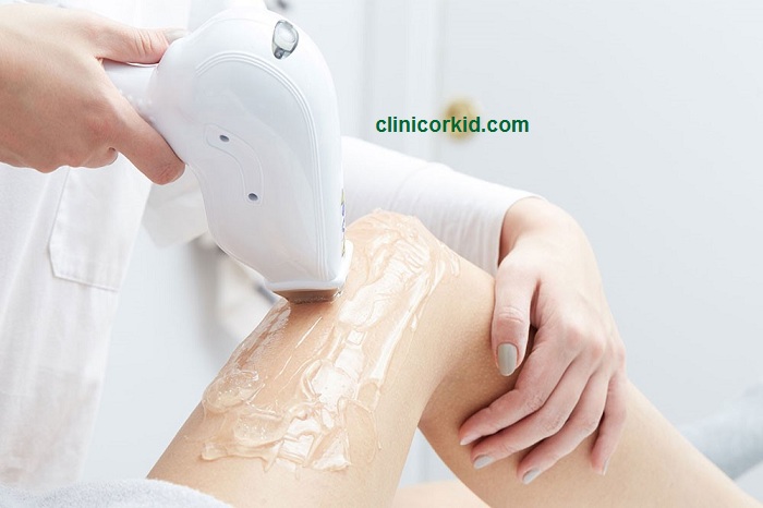 تخفیف لیزر موهای زائد - کلینیک ارکید