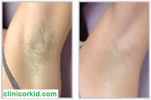 لیزر زیر بغل در غرب تهران کلینیک ارکید