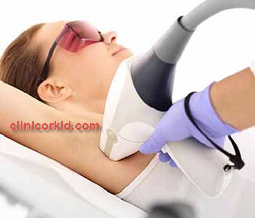 قیمت لیزر موهای بدن بانوان کلینیک ارکید