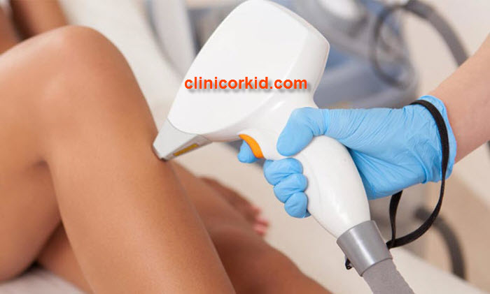 هزینه لیزر موهای زائد زنان - کلینیک ارکید