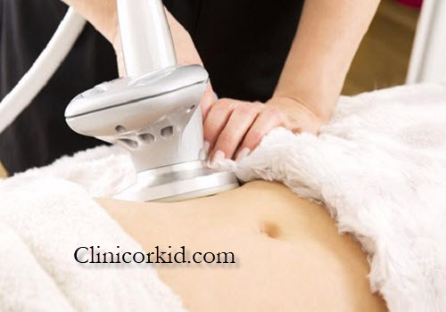 تخمدان پلی کیستیک و لیزر موهای زائد - کلینیک ارکید