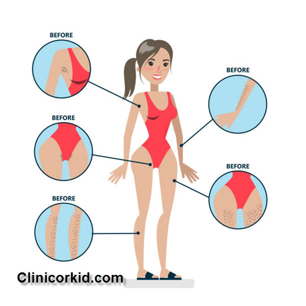 قیمت لیزر کردن موهای زائد - کلینیک ارکید