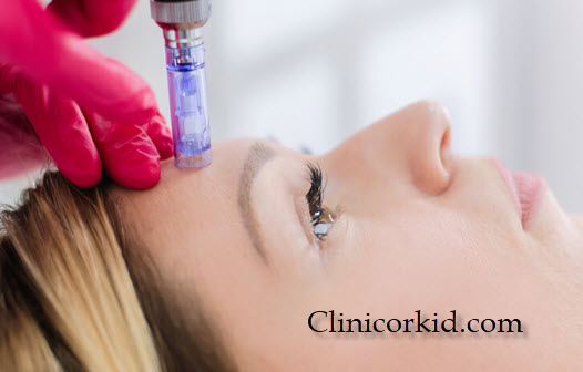 لیزر موهای زائد پیشانی - کلینیک ارکید