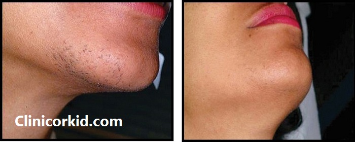 از بین بردن موهای زائد صورت با لیزر - کلینیک ارکید