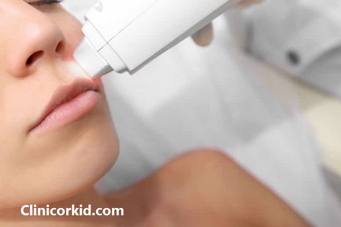 از بین بردن موهای زائد صورت با لیزر - کلینیک ارکید