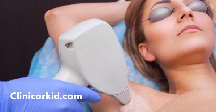 هزینه رفع موهای زائد با لیزر - کلینیک ارکید