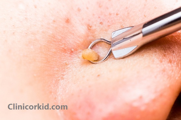 آموزش پاکسازی صورت با میله پیلینگ - کلینیک ارکید