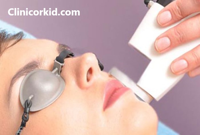 لیزر دائمی موهای صورت در غرب تهران - کلینیک ارکید