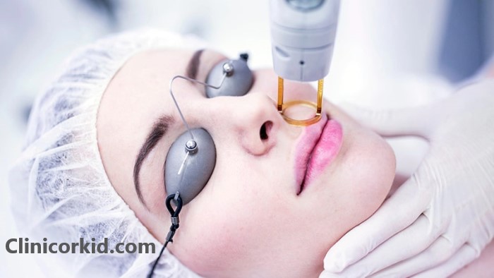 لیزر دائمی موهای صورت در غرب تهران - کلینیک ارکید