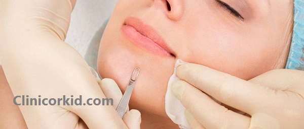 آموزش پاکسازی صورت با میله پیلینگ کلینیک ارکید