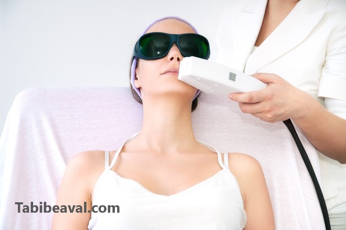 بهترین نوع لیزر موی زائد - کلینیک ارکید