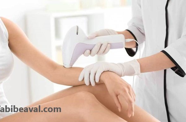 بهترین نوع لیزر موی زائد کلینیک ارکید