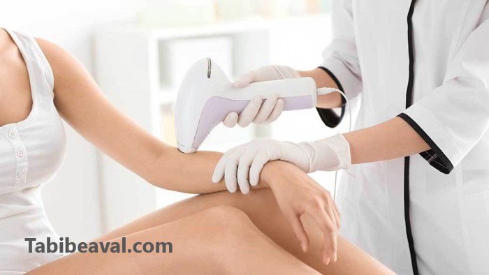 بهترین نوع لیزر موی زائد کلینیک ارکید