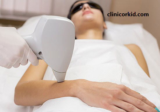 نکات قابل توجه در لیزر موهای زائد - کلینیک ارکید