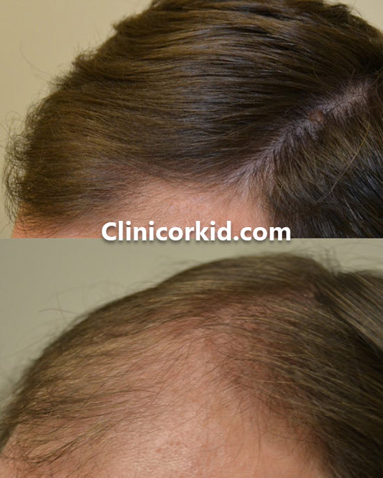 اهمیت مراقبت بعد از مزوتراپی مو | کلینیک ارکید