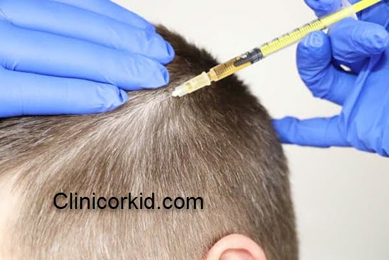 اهمیت مراقبت بعد از مزوتراپی مو | کلینیک ارکید