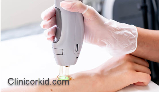 لیزر موهای زائد با قیمت مناسب همراه با تخفیف های ویژه | کلینیک ارکید