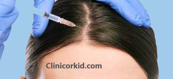نحوه تزریق مزوتراپی مو - کلینیک ارکید