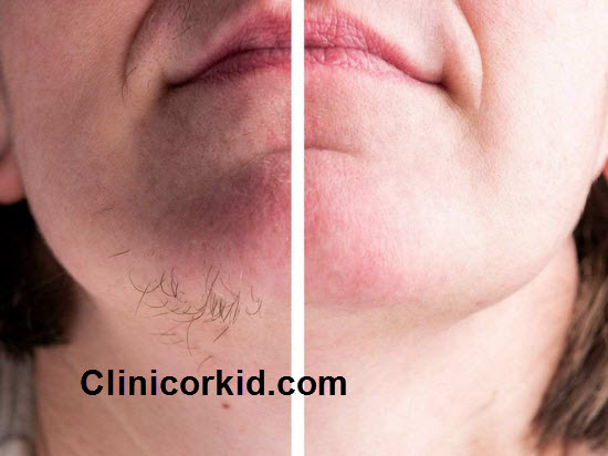 هزینه لیزر موهای زائد صورت - کلینیک ارکید