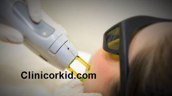 هزینه لیزر موهای زائد صورت - کلینیک ارکید