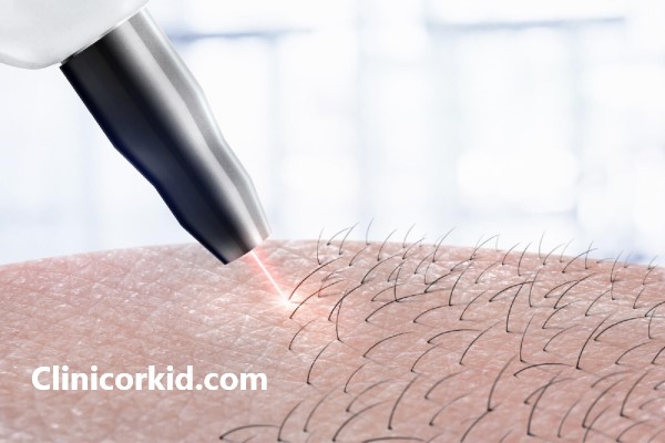 ایا لیزر موهای زائد سرطان زاست؟ کلینیک ارکید