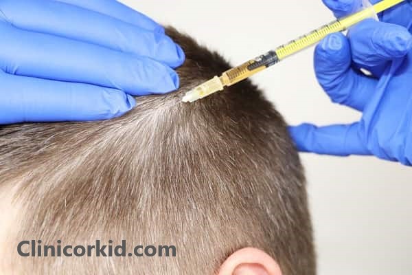نحوه تزریق مزوتراپی مو - کلینیک ارکید